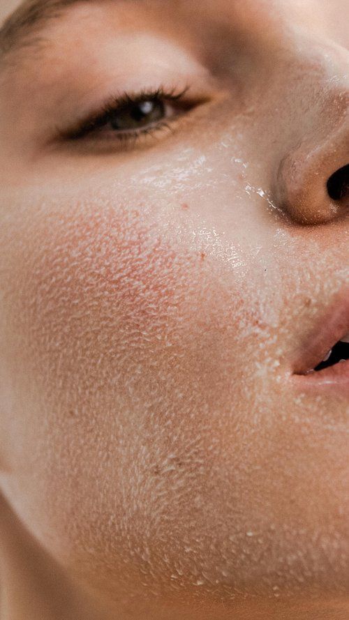 Dry Skin
