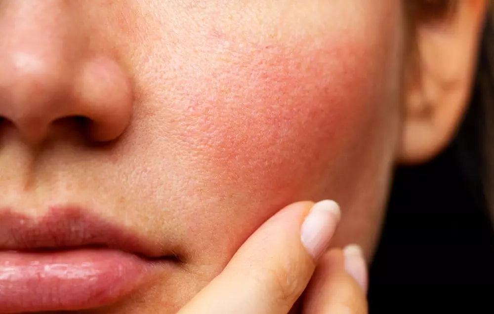 Sensitive Skin