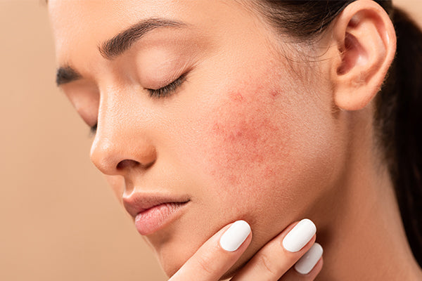 Acne-Prone Skin