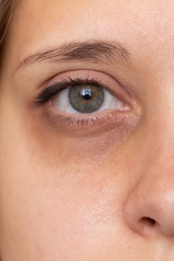 Dark Circles & Puffiness